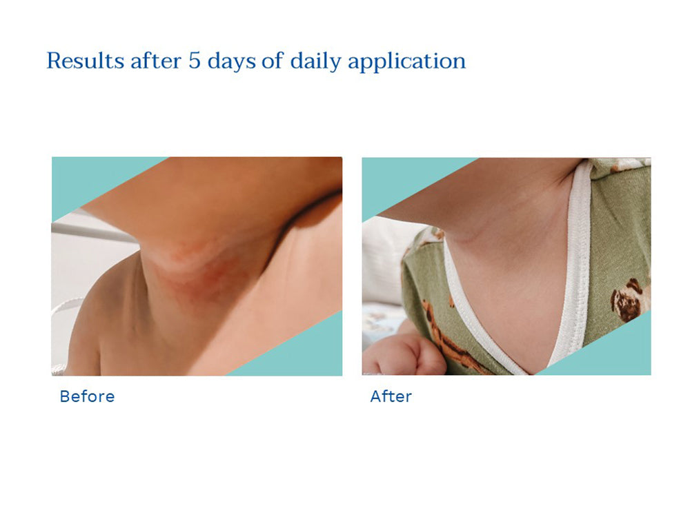 Stelatopia intense eczema relief